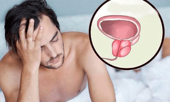 Sintomi di prostatite