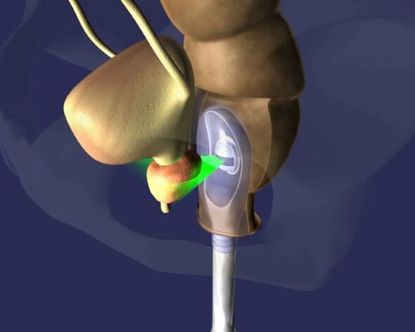 Trattamento ecografico della prostata per prostatite