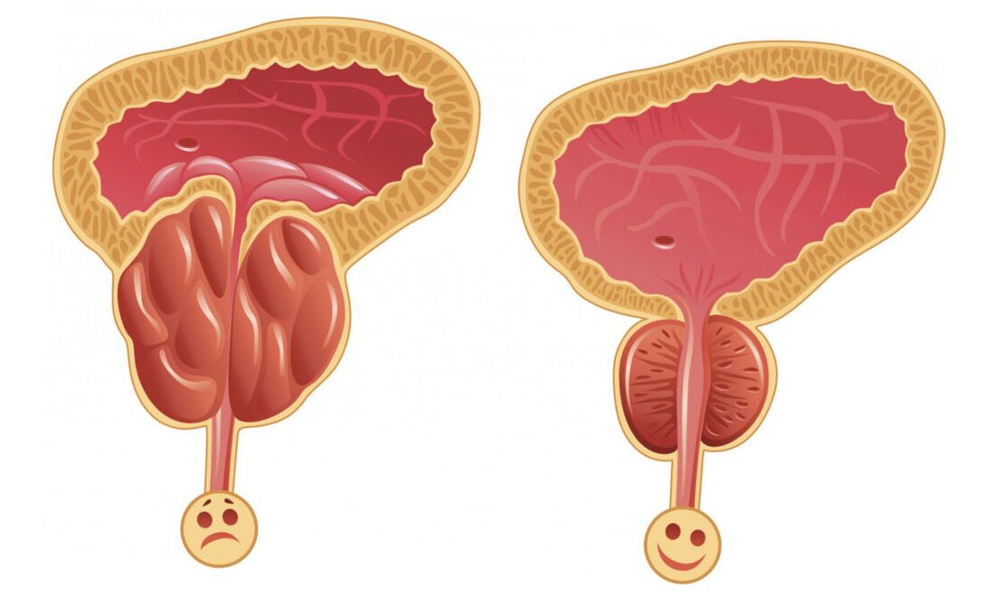 Infiammazione della prostata con prostatite (a sinistra) e la prostata è normale (a destra)
