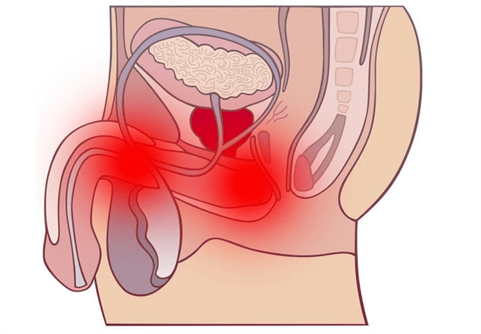 Infiammazione del tratto genitale con prostatite